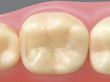 コンポジットレジン