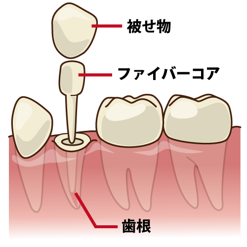 茗荷谷駅徒歩2分の歯医者｜佐藤歯科医院の根管治療