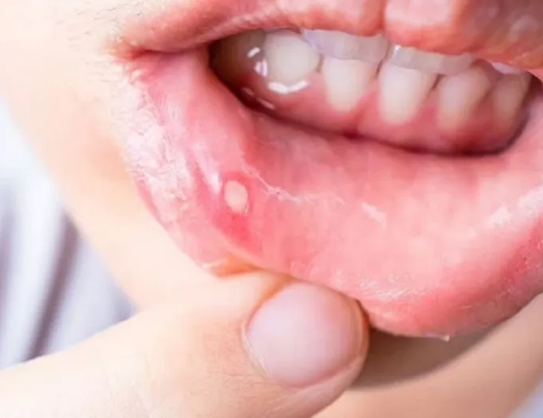 茗荷谷駅徒歩2分の歯医者｜佐藤歯科医院のお口の中のデキモノ