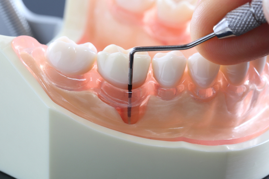 茗荷谷駅徒歩2分の歯医者｜佐藤歯科医院の歯周病治療