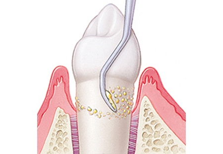 茗荷谷駅徒歩2分の歯医者｜佐藤歯科医院の歯周病治療