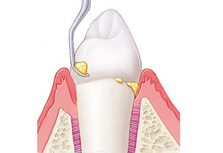 茗荷谷駅徒歩2分の歯医者｜佐藤歯科医院の歯周病治療
