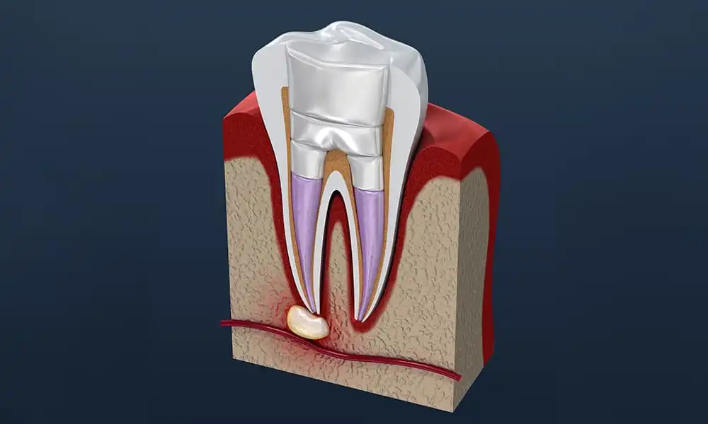 茗荷谷駅徒歩2分の歯医者｜佐藤歯科医院の根管治療